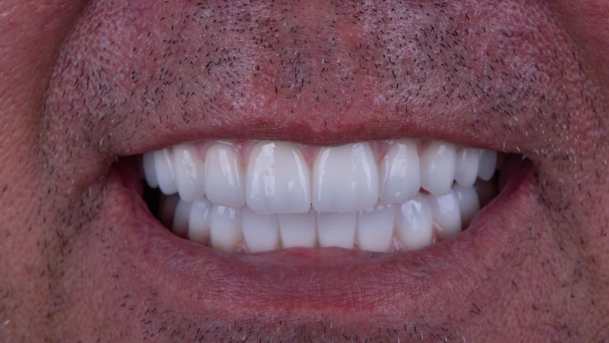 After — Complete smile transformation