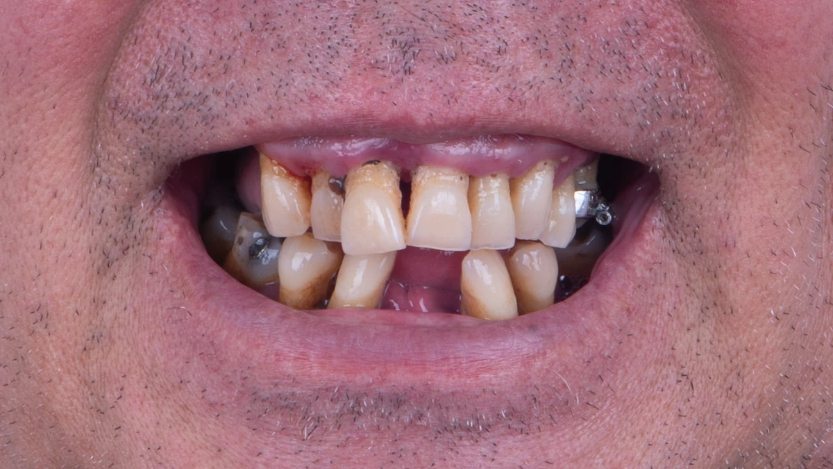 Before — Complete smile transformation