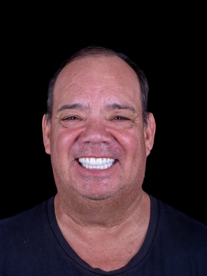 After — Complete smile transformation, portrait