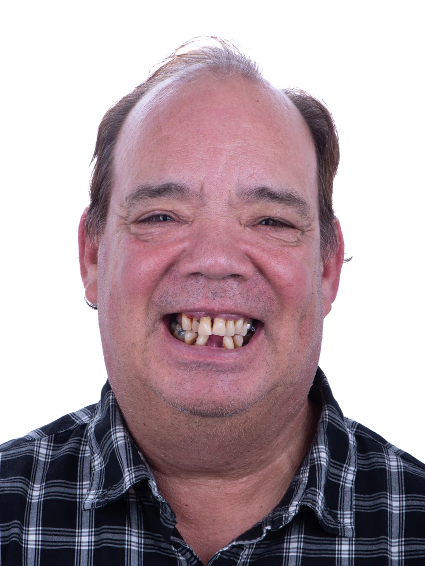 Before — Complete smile transformation, portrait