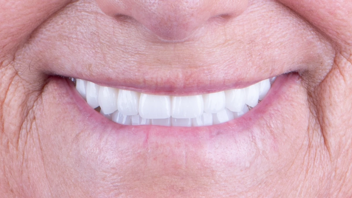After — Complete smile transformation
