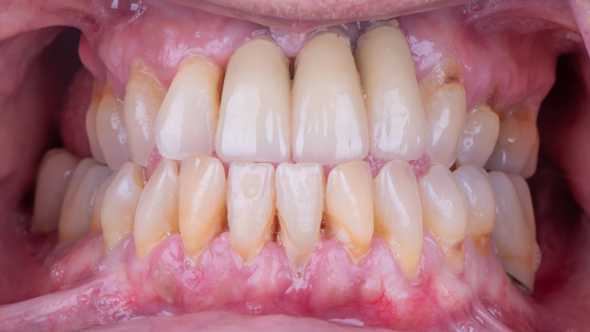 Before — Complete smile transformation