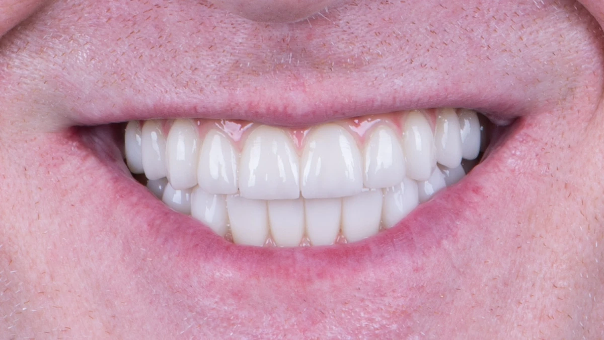 After — Complete smile transformation