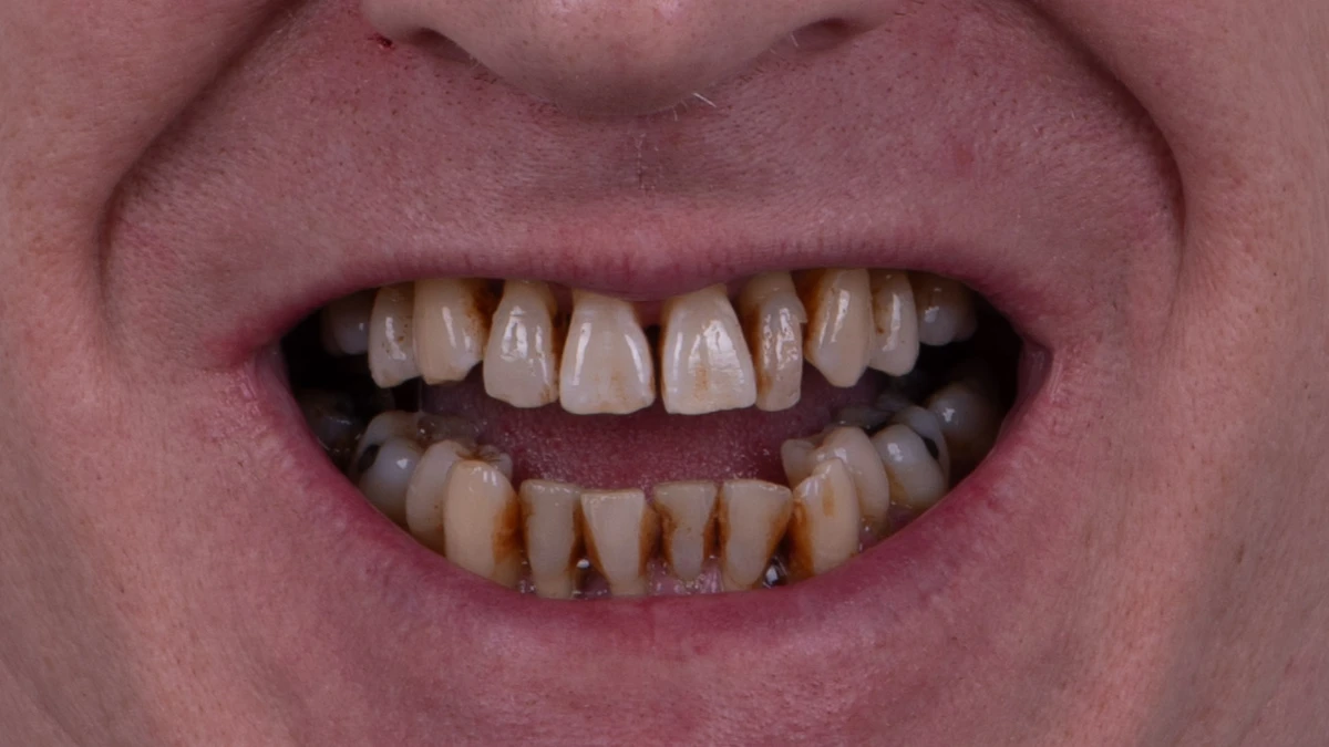Before — Complete smile transformation