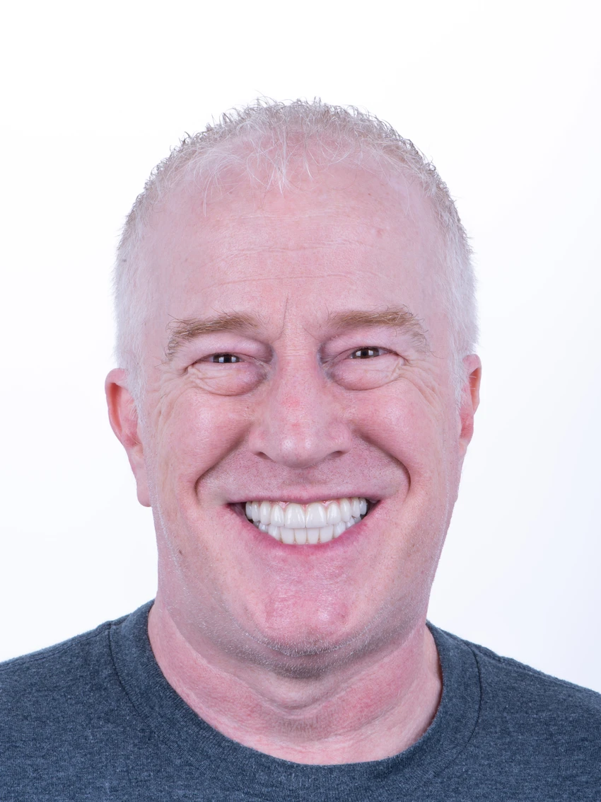 After — Complete smile transformation, portrait