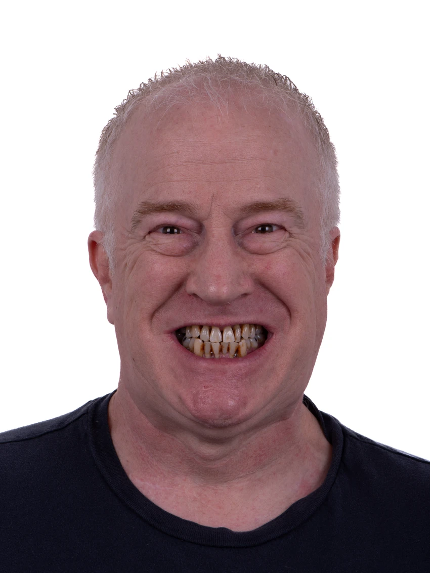 Before — Complete smile transformation, portrait