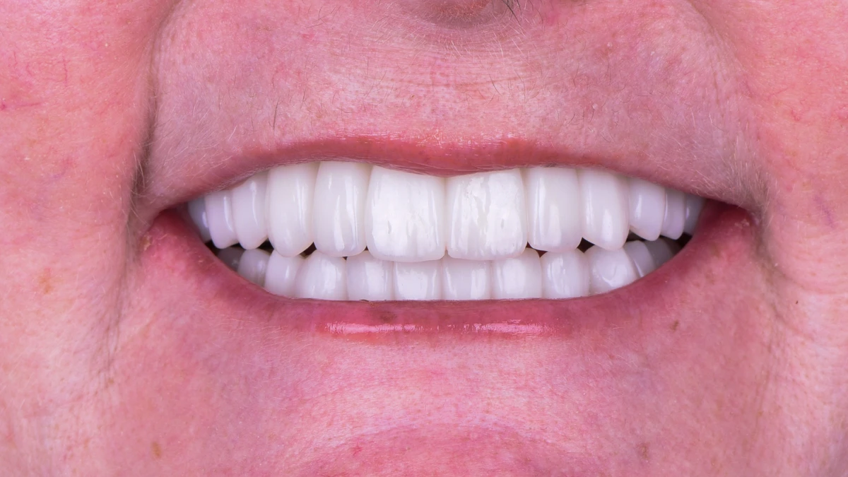 After — Complete smile transformation