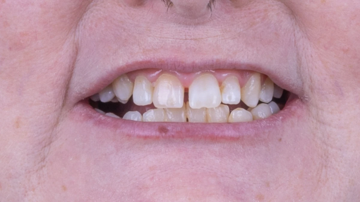 Before — Complete smile transformation