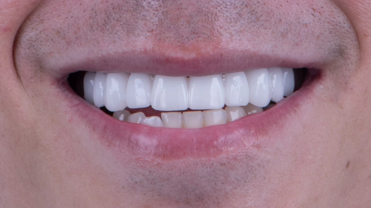 After — Complete smile transformation