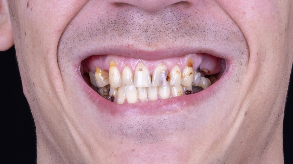 Before — Complete smile transformation