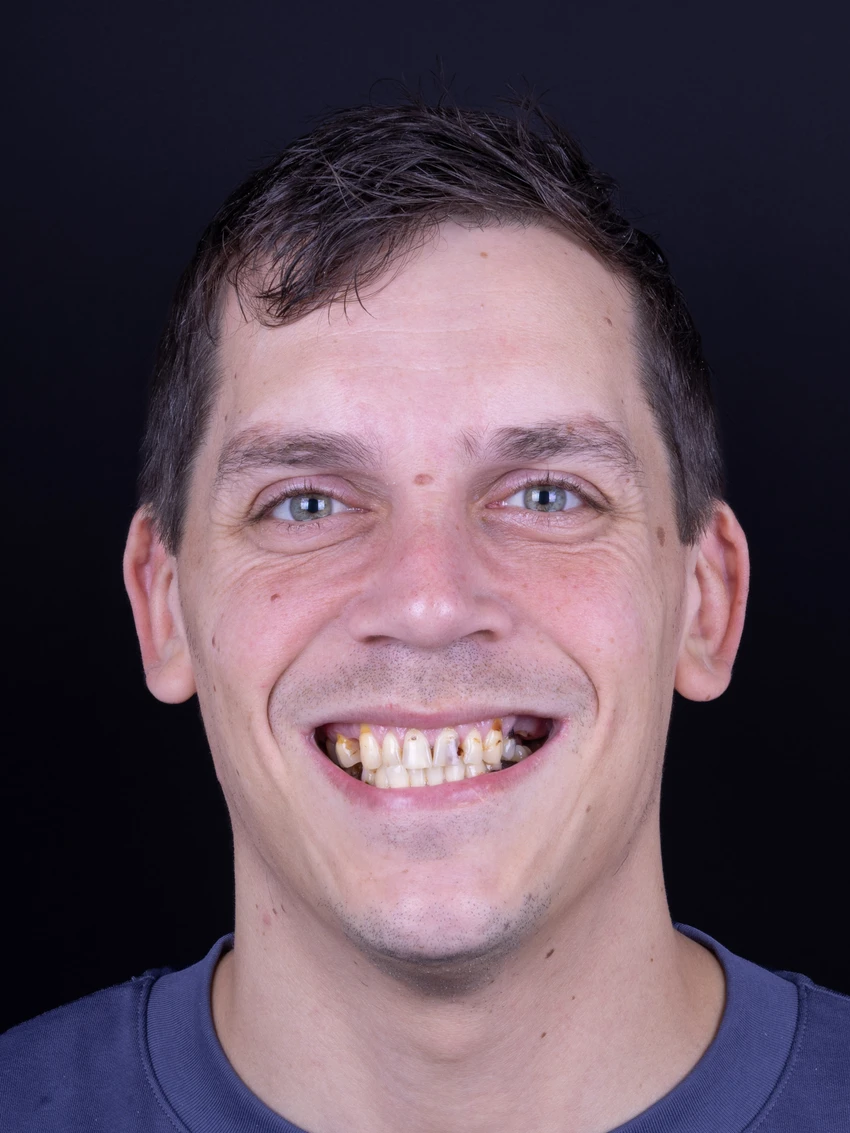 Before — Complete smile transformation, portrait