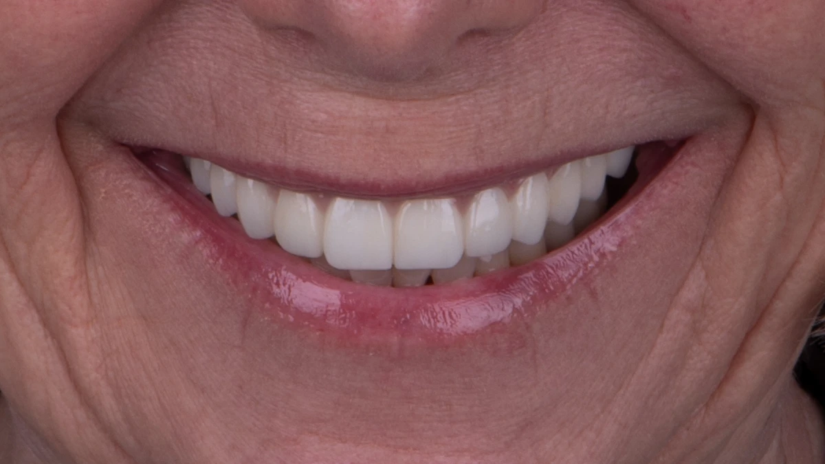After — Complete smile transformation