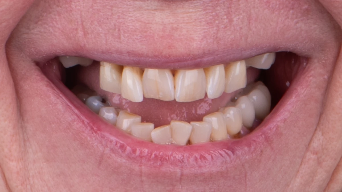 Before — Complete smile transformation
