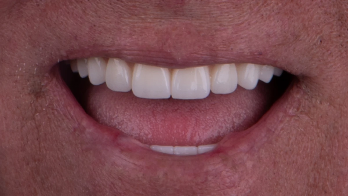After — Complete smile transformation
