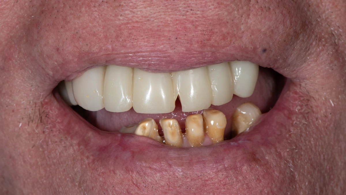 Before — Complete smile transformation