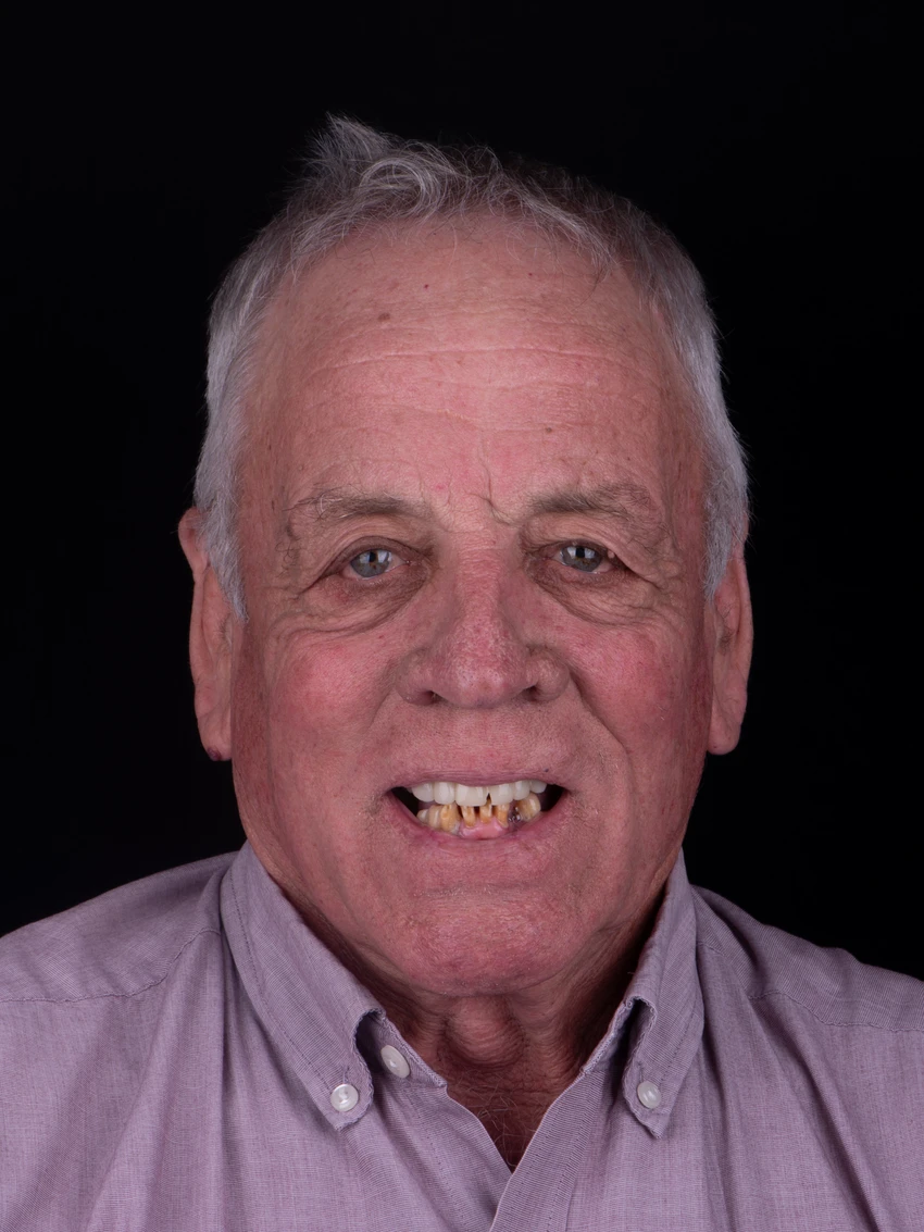 Before — Complete smile transformation, portrait