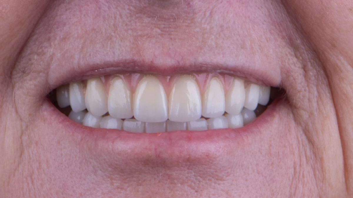 After — Complete smile transformation