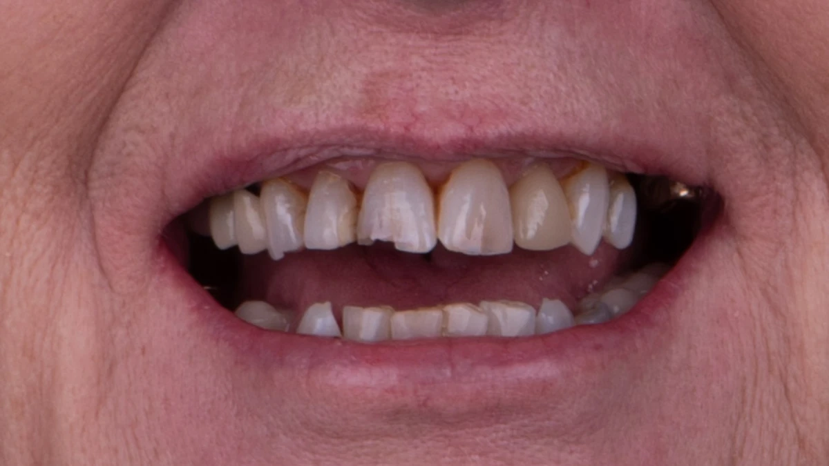 Before — Complete smile transformation