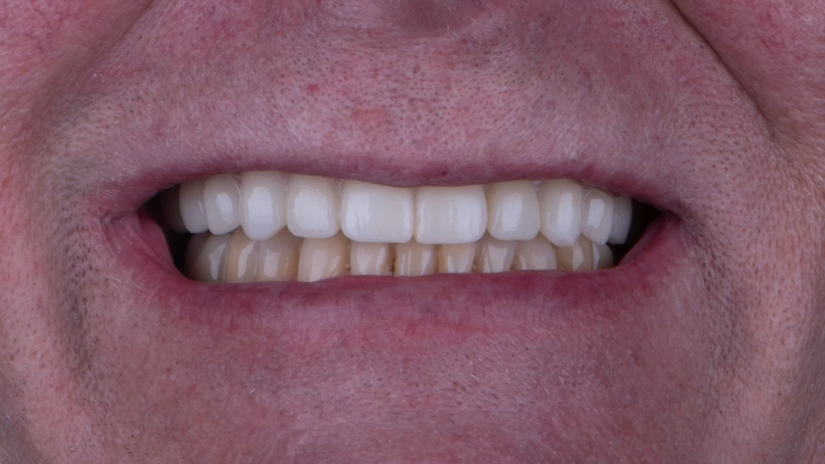After — Complete smile transformation