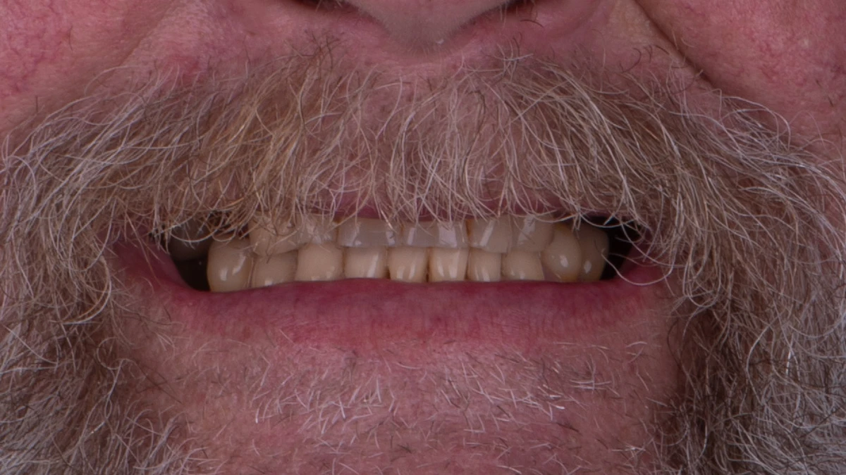 Before — Complete smile transformation