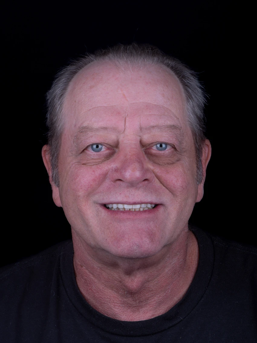 After — Complete smile transformation, portrait
