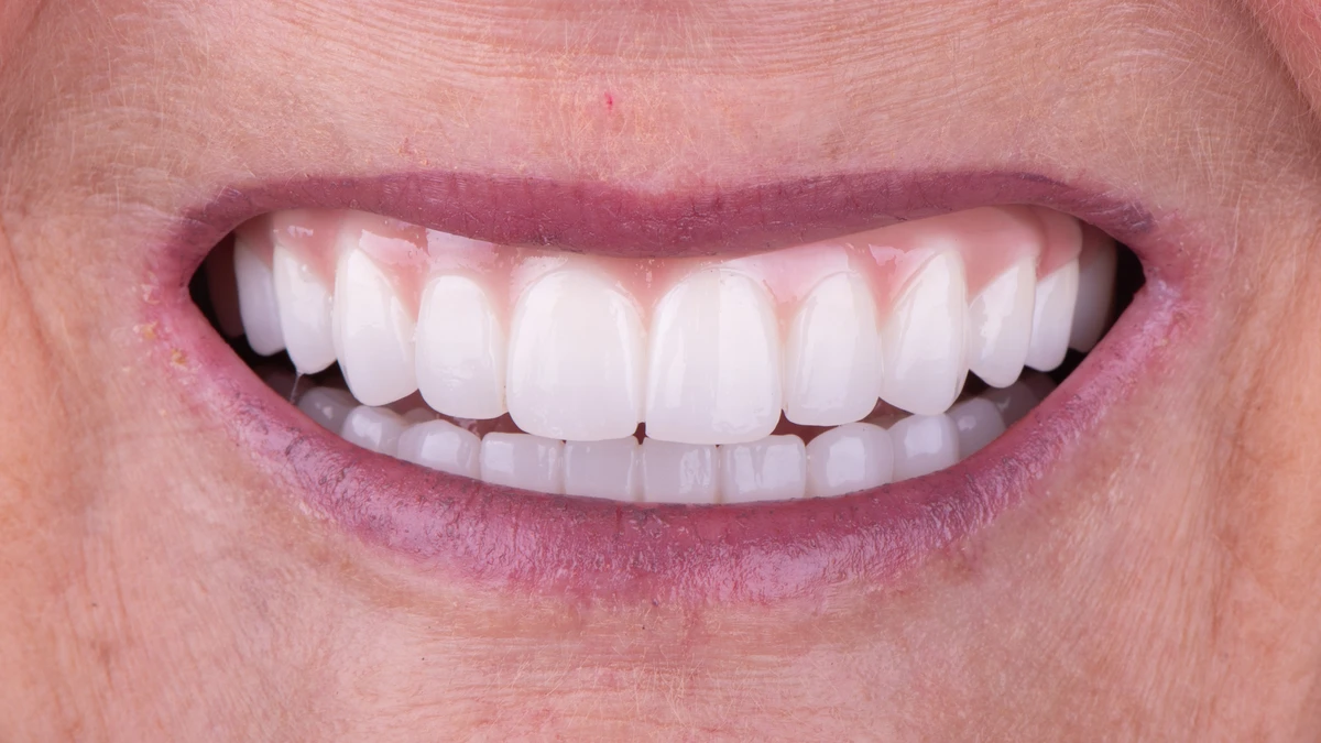 After — Complete smile transformation