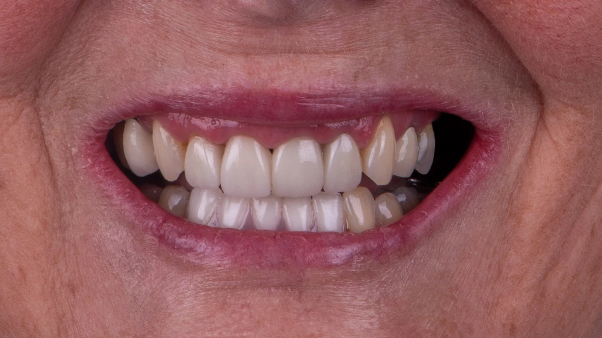 Before — Complete smile transformation