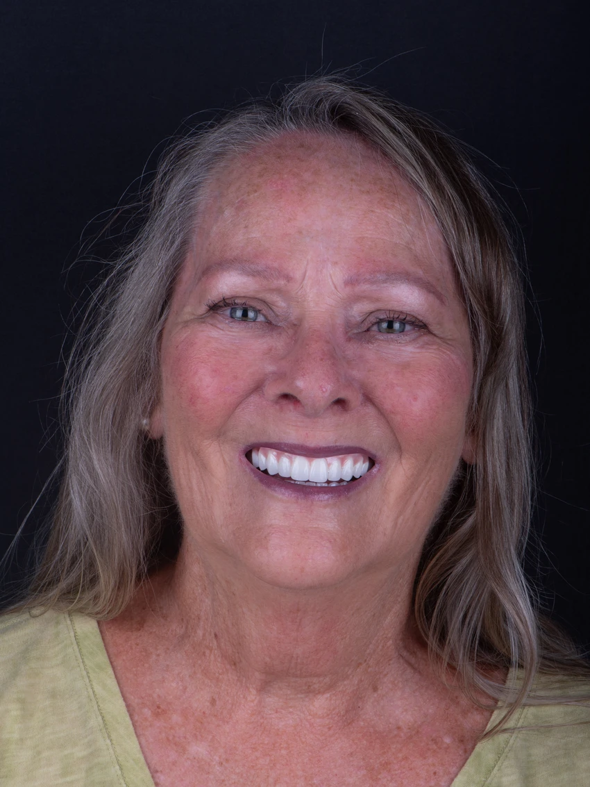 After — Complete smile transformation, portrait