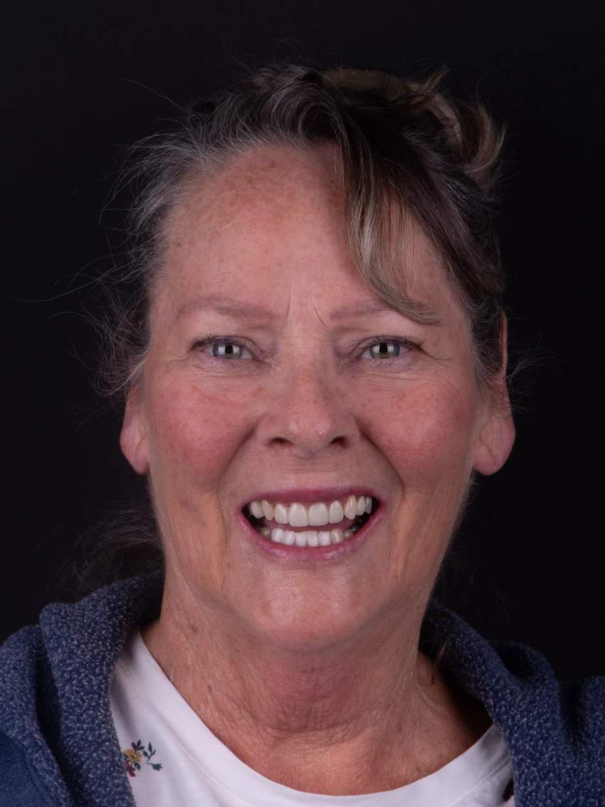 Before — Complete smile transformation, portrait