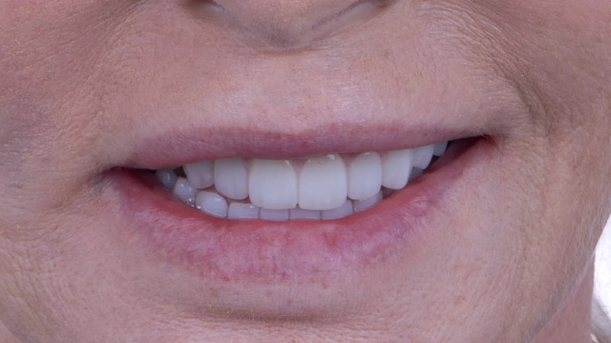 After — Complete smile transformation