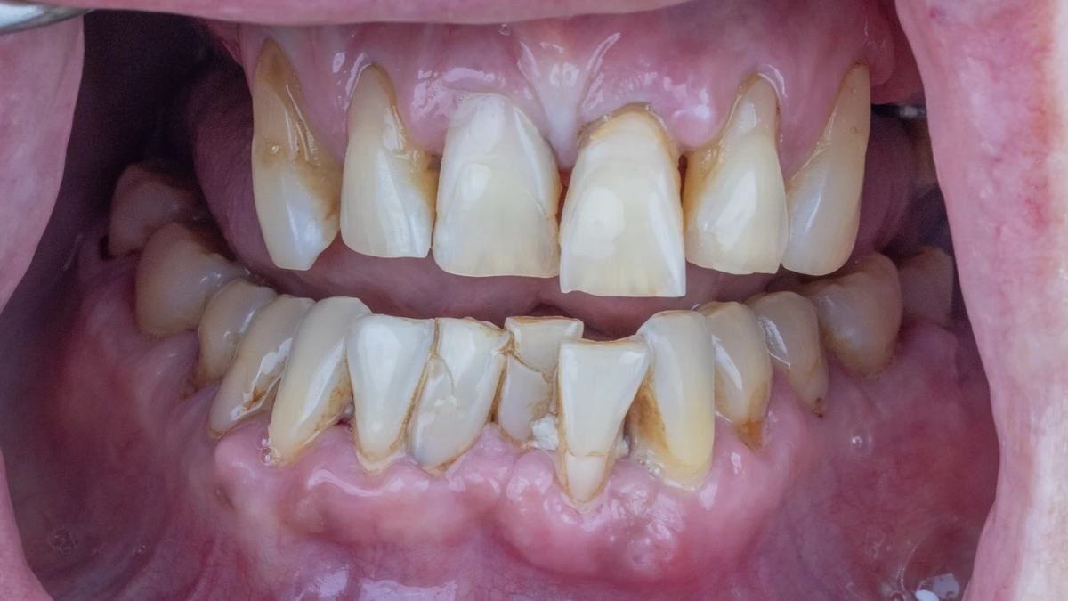 Before — Complete smile transformation