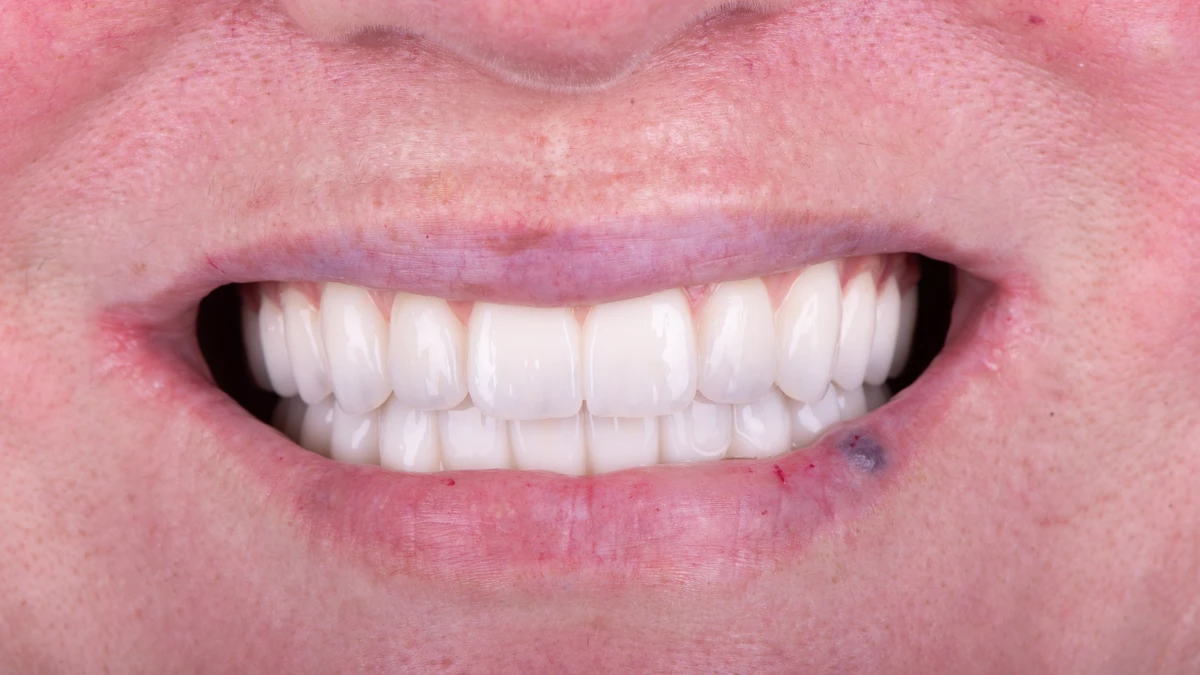 After — Complete smile transformation