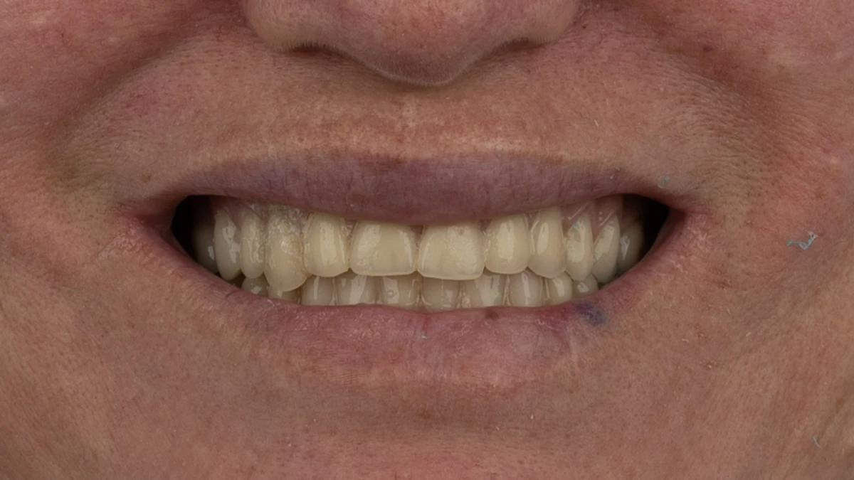 Before — Complete smile transformation