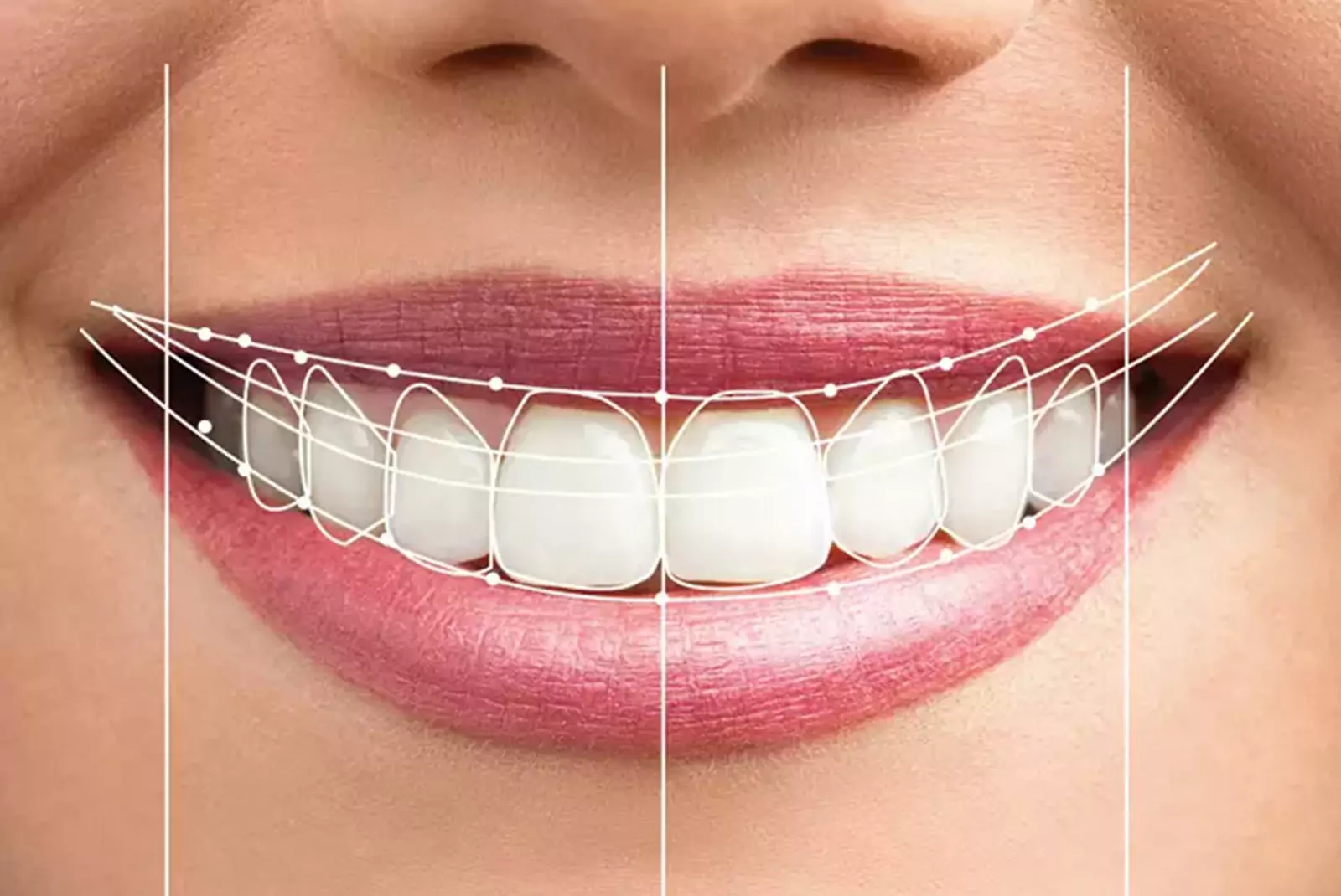 Smile design preview — a patient's photo transformed to show their smile after All-on-4