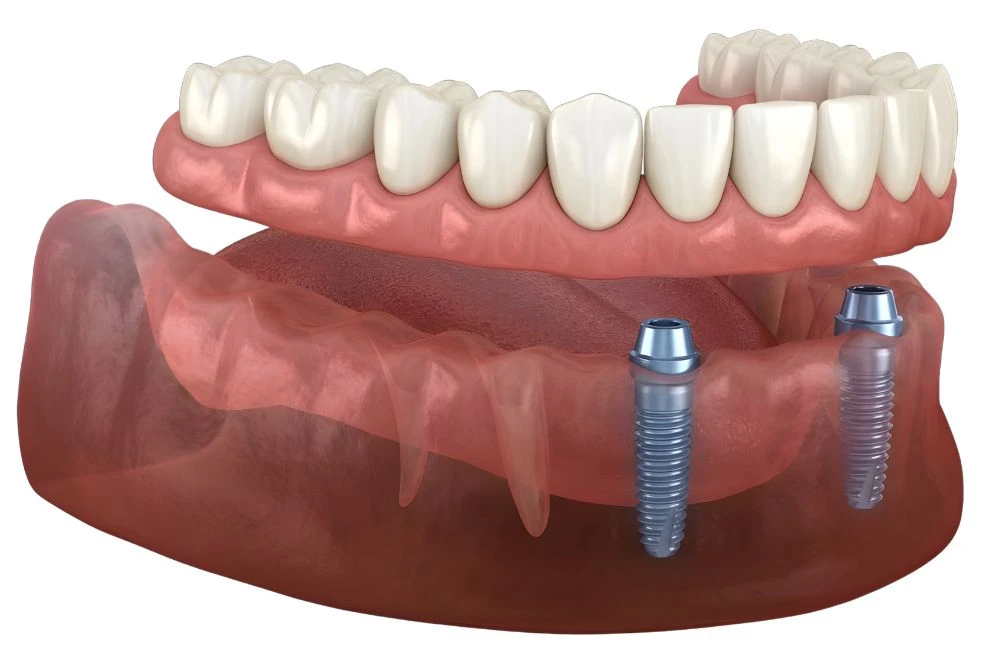 Snap-In Dentures
