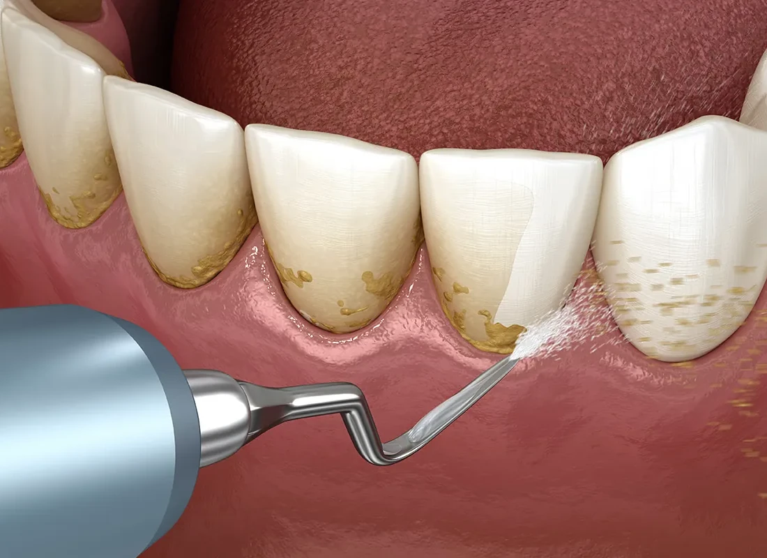 What is Teeth Cleaning (Prophy)
