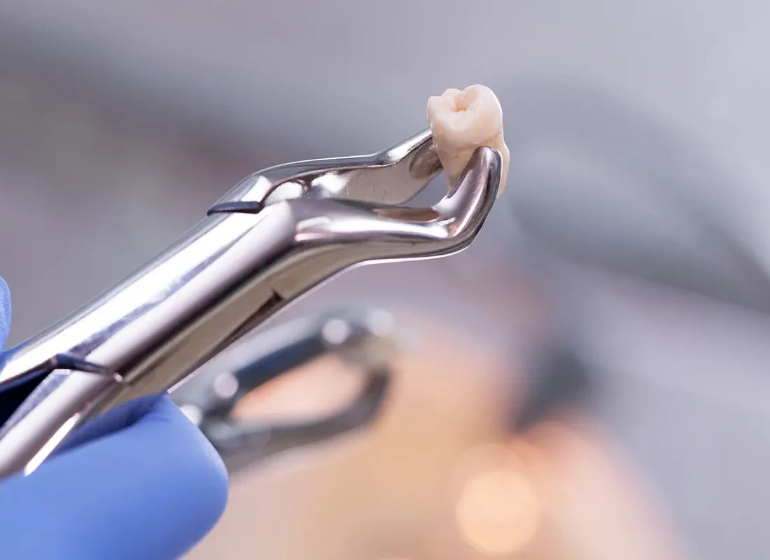 What is Tooth Extraction
