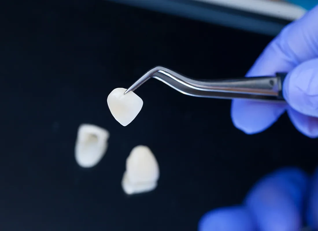Porcelain veneers, layered for a natural look