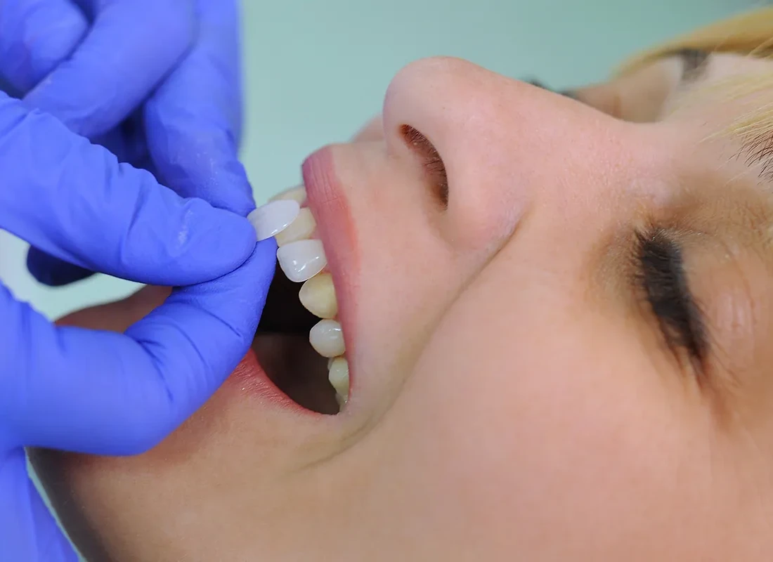 Will Veneers Harm My Real Teeth?