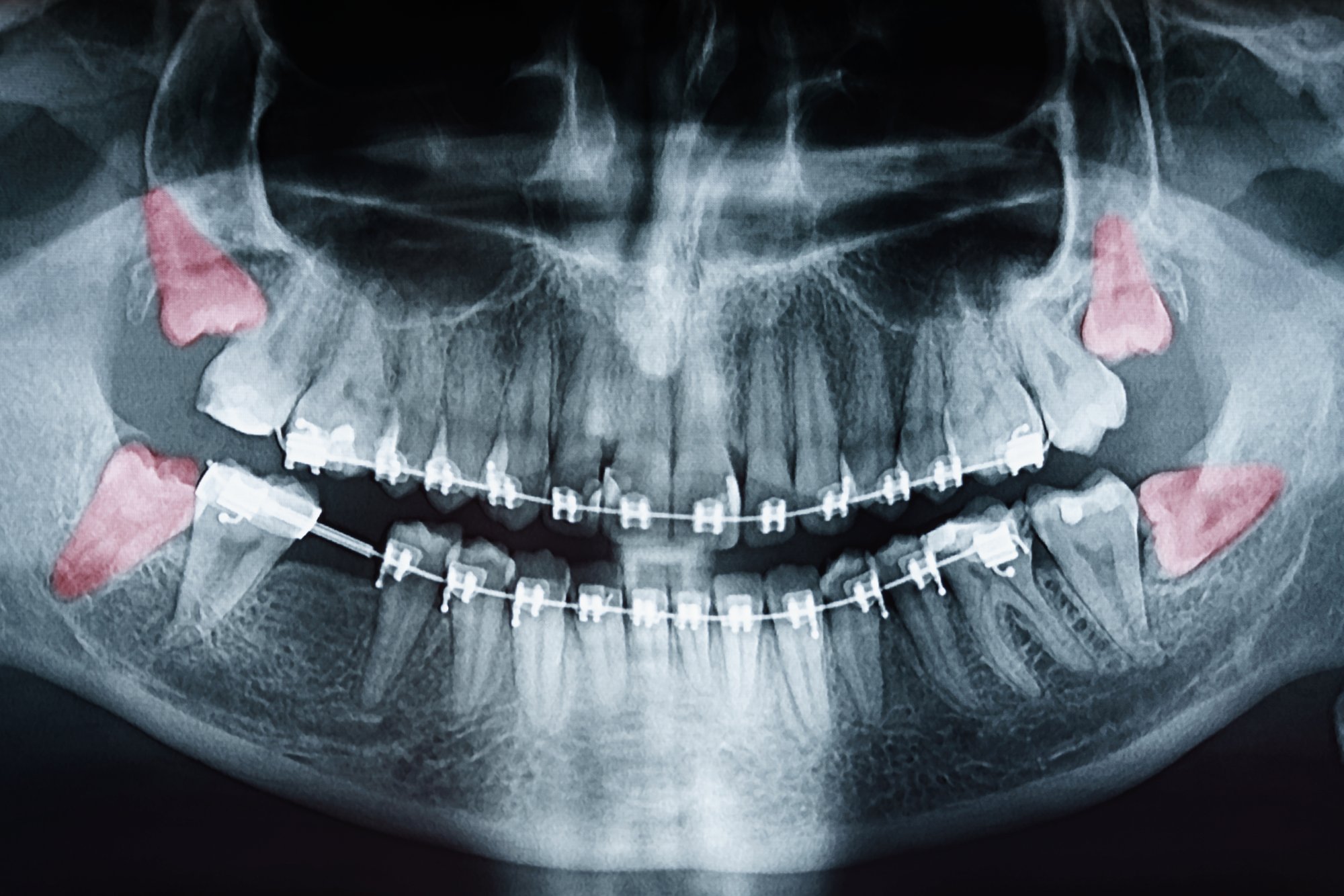 What's the Best Age to Remove Wisdom Teeth?
