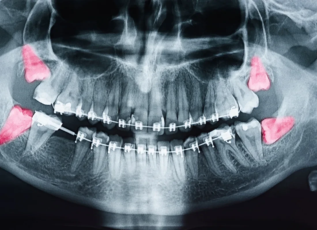 What is Wisdom Teeth Removal